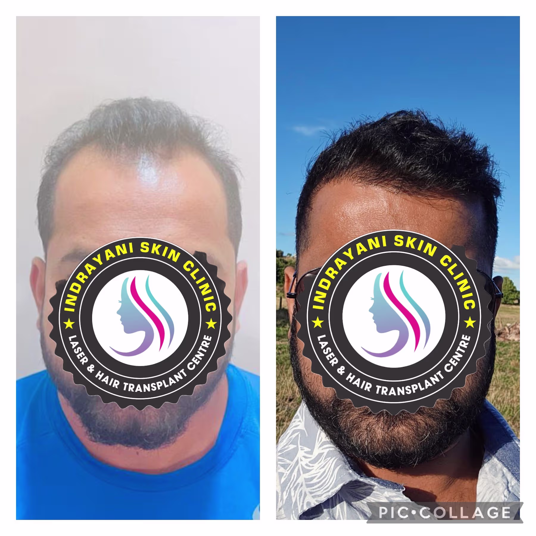 inrayani-skin-clinic-results