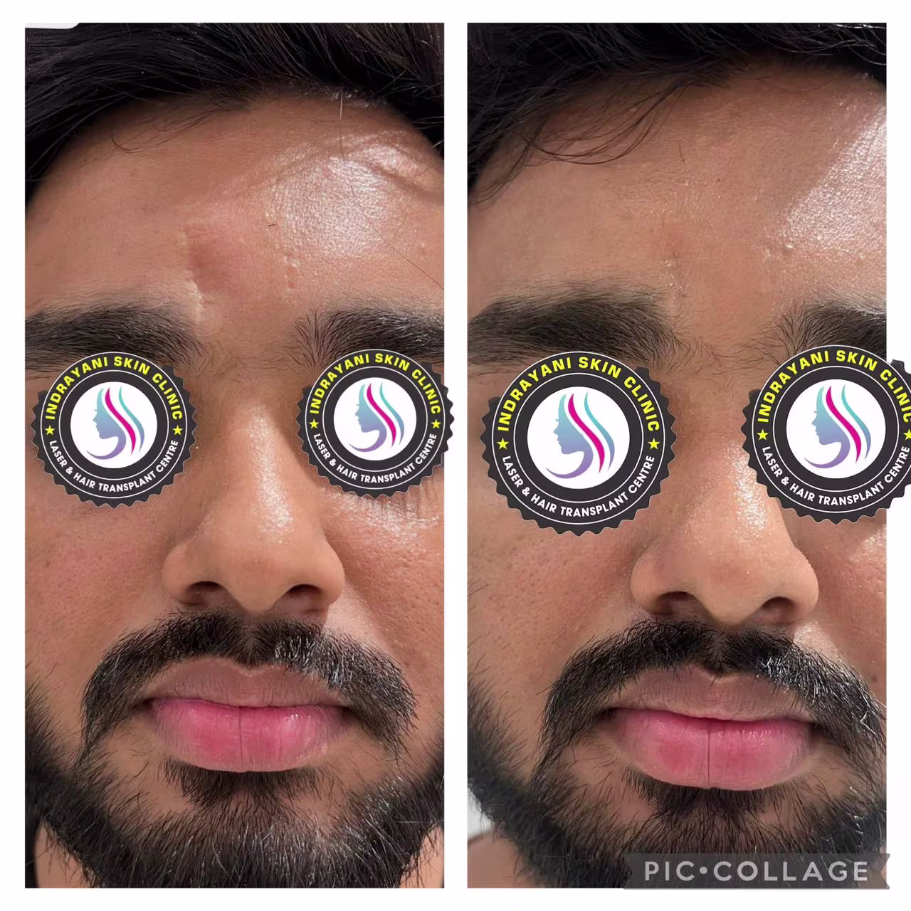 inrayani-skin-clinic-results