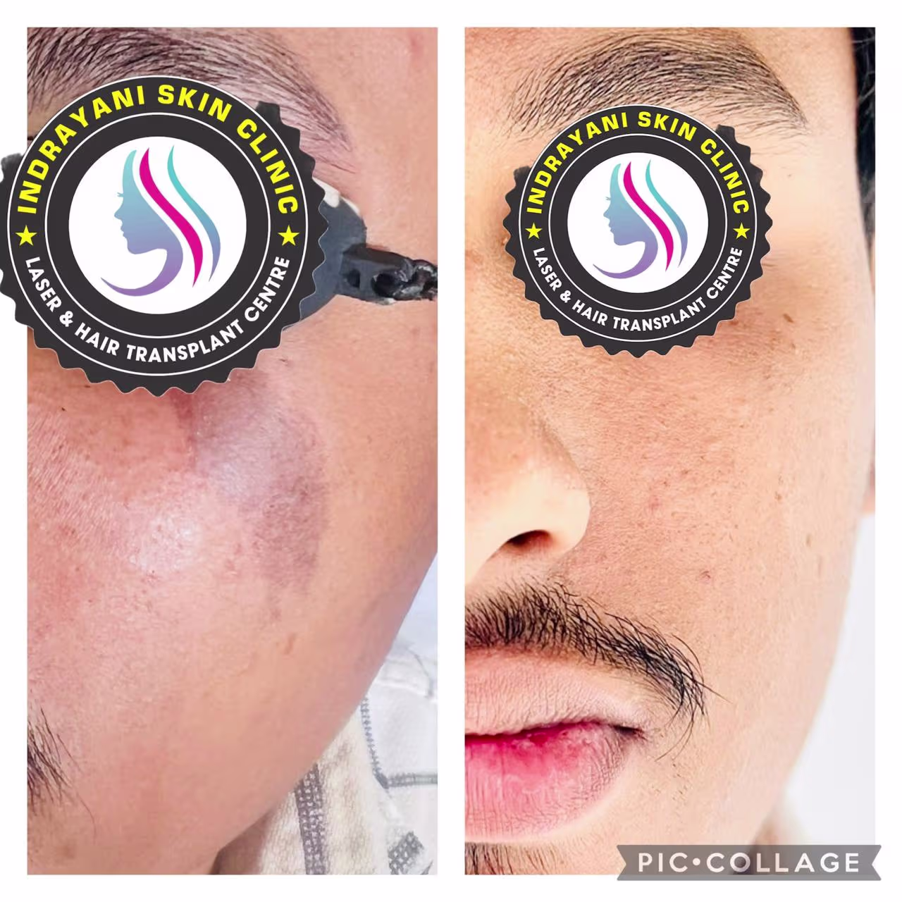 inrayani-skin-clinic-results