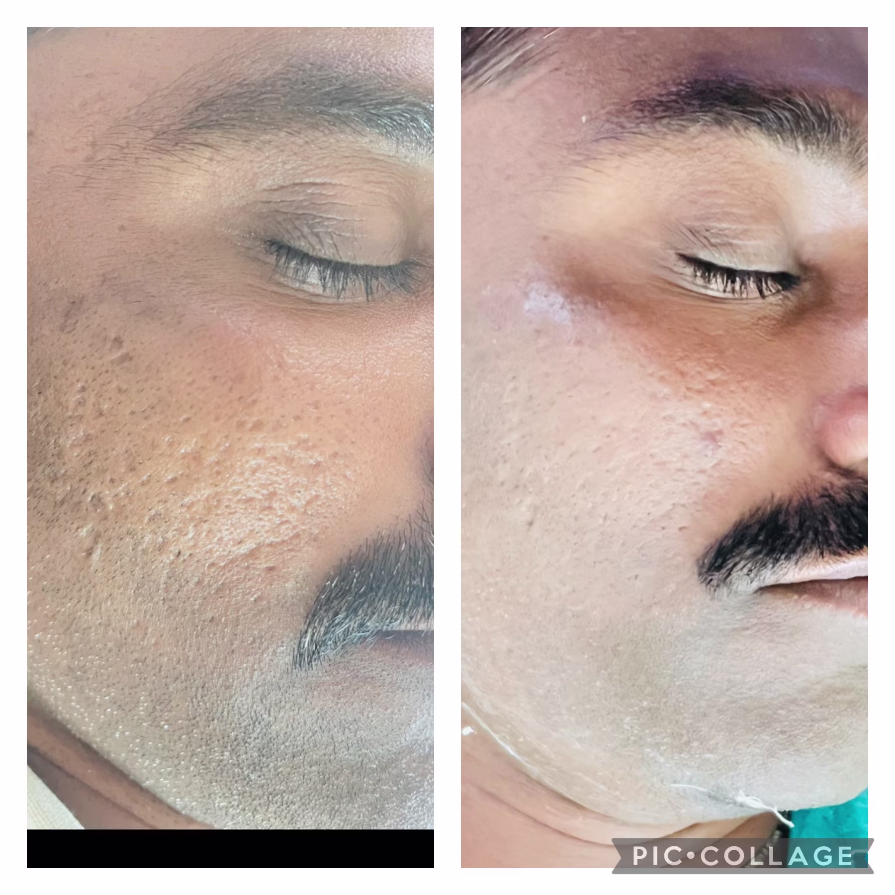 inrayani-skin-clinic-results